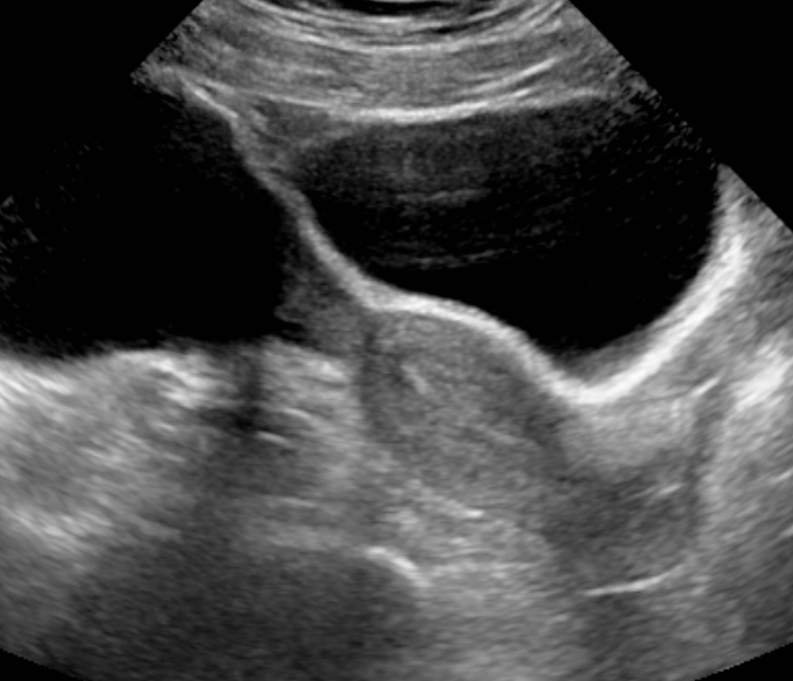 free fluid in pelvis on ultrasound
